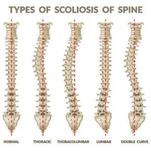 Scoliosis in Eureka MO