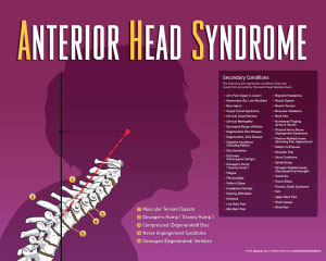 Chiropractic Eureka MO Anterior Head Syndrome